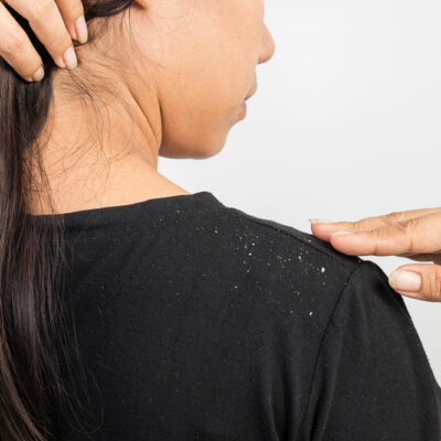 7 Effective Home Remedies for Dandruff