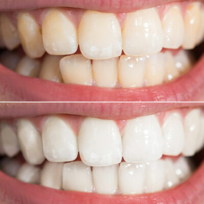6 Top Teeth Whitening Procedures