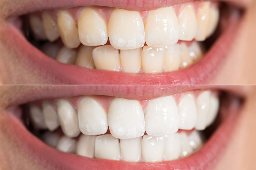 6 Top Teeth Whitening Procedures
