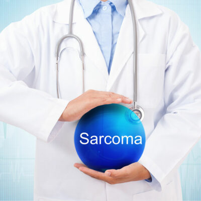 A Guide on Common Types of Sarcoma