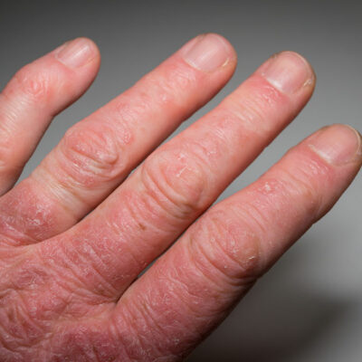 The Worst American Cities for Arthritis Patients