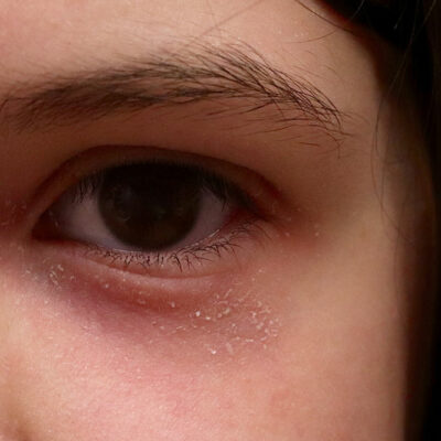 The Worst Cities to Live in With Atopic Dermatitis