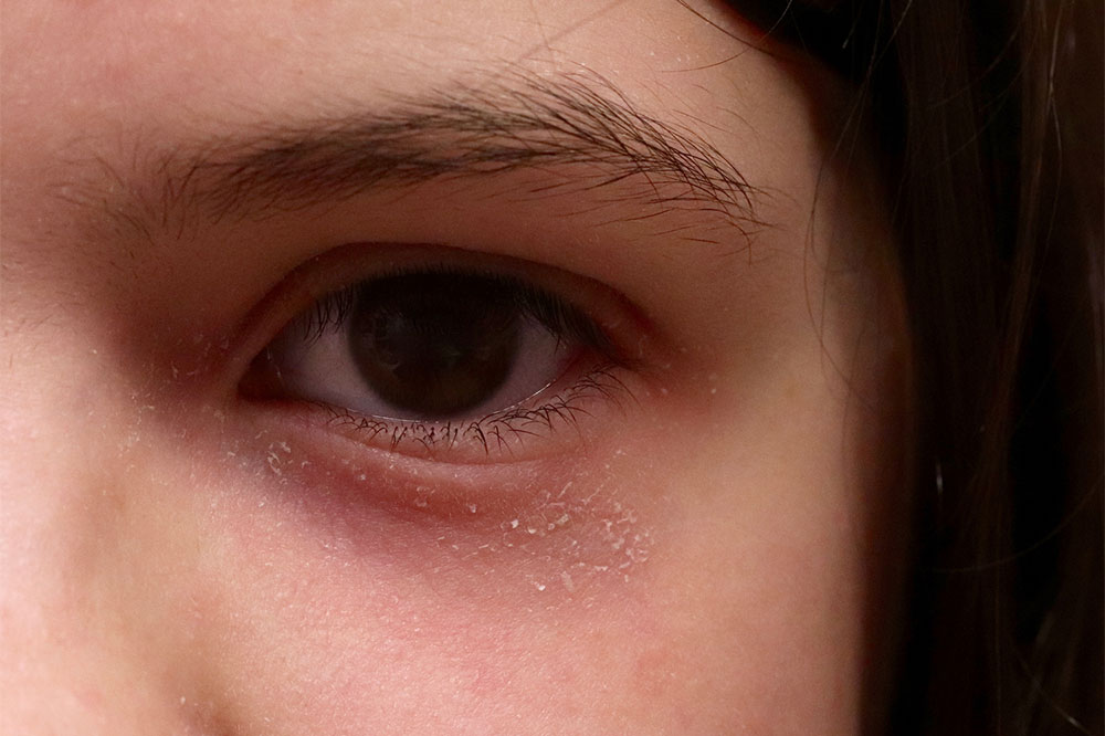 The Worst Cities to Live in With Atopic Dermatitis